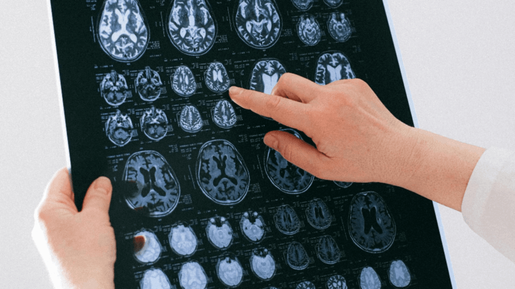 Afectiuni cerebrale tot mai frecvente in Romania