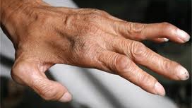 caz nou de lepra confirmat la cluj napoca