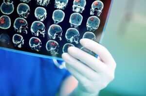 A facut un RMN din cauza durerilor de spate dar medicii i au gasit o tumoare cerebrala Simptomele comune pe care le a ignorat o femeie de 38 de ani Am crezut ca o sa mor