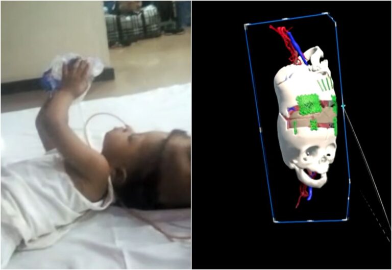 gemene siameze cu craniile fuzionate separate cu succes prin interventii ajutate de inteligenta artificiala cum arata acum fetele de trei ani