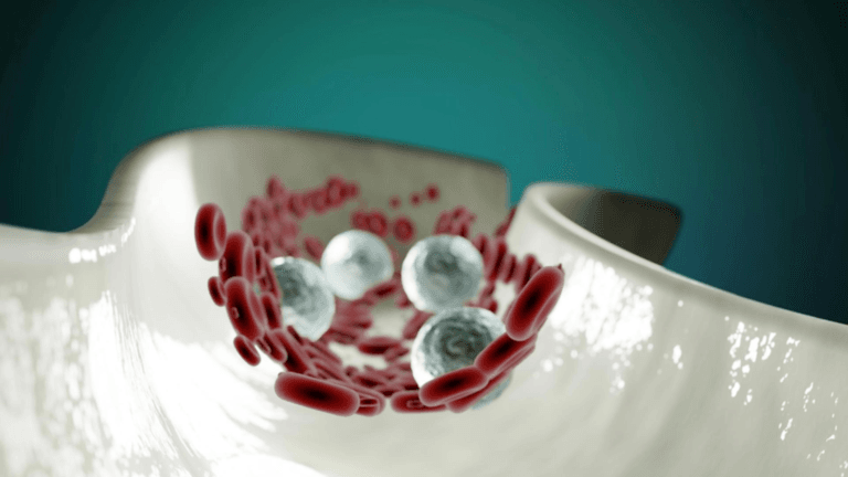 Boală inflamatorie ce afectează vasele de sânge Boala inflamatorie ce afecteaza vasele de sange