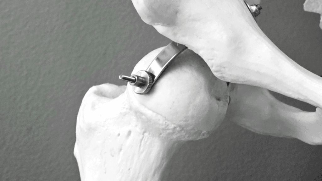 Primele simptome ale osteoporozei Semne alarmante si sfaturi medicale