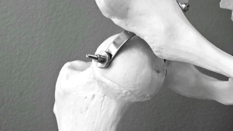 Primele simptome ale osteoporozei Semne alarmante si sfaturi medicale